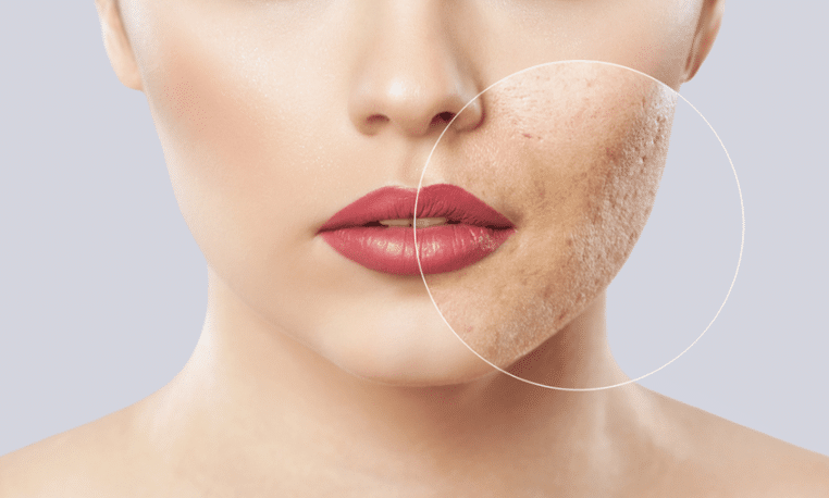 Subcision treatment