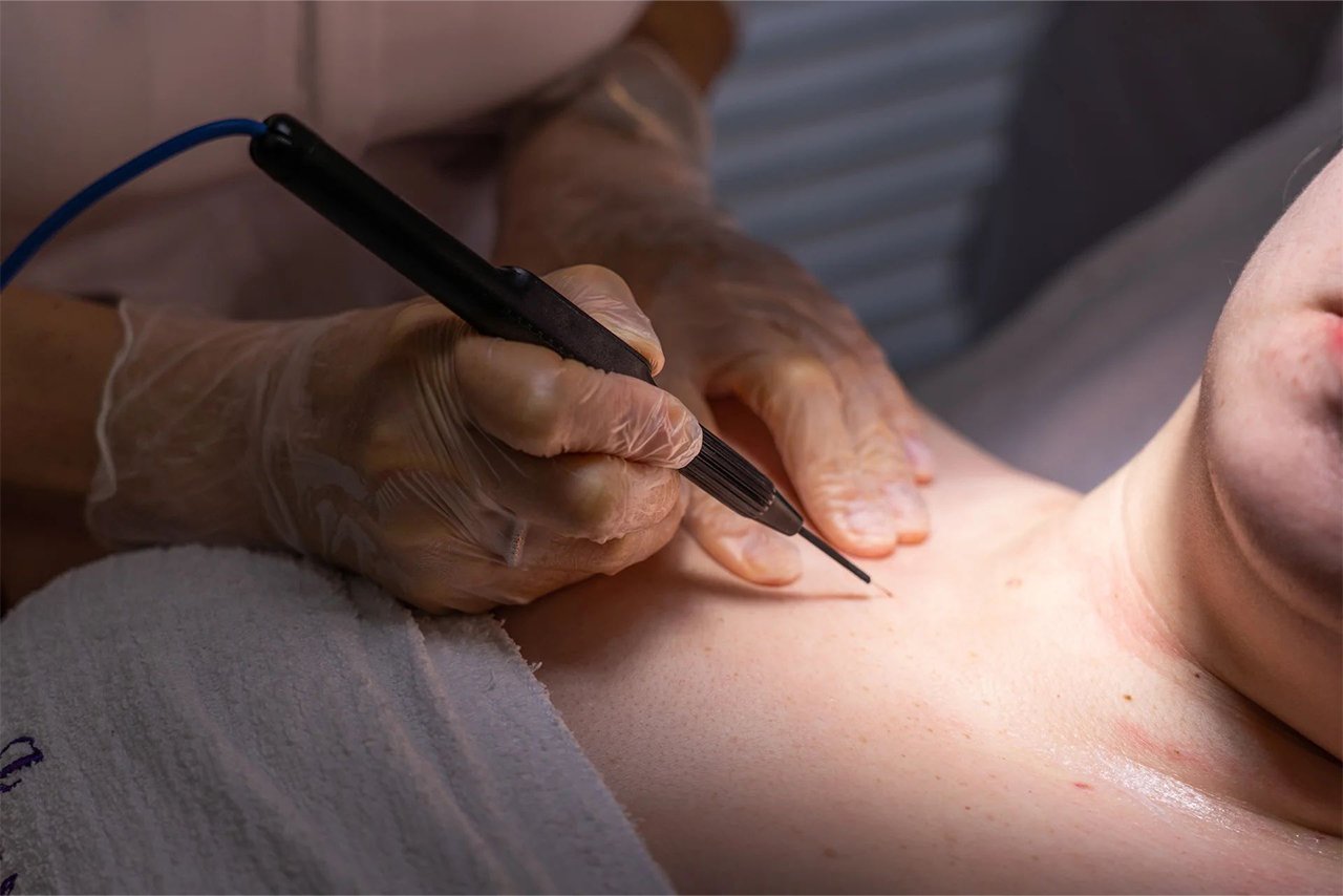 RF Cautery