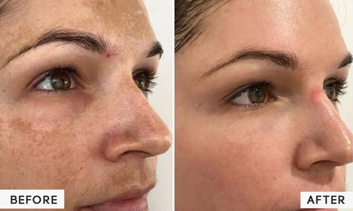 Cosmelan Treatment